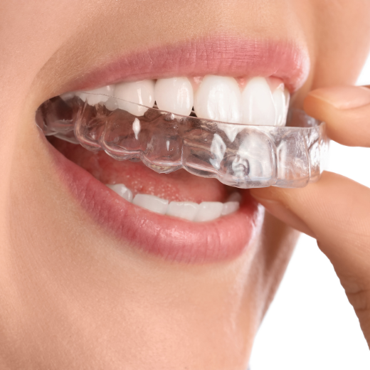 aligners