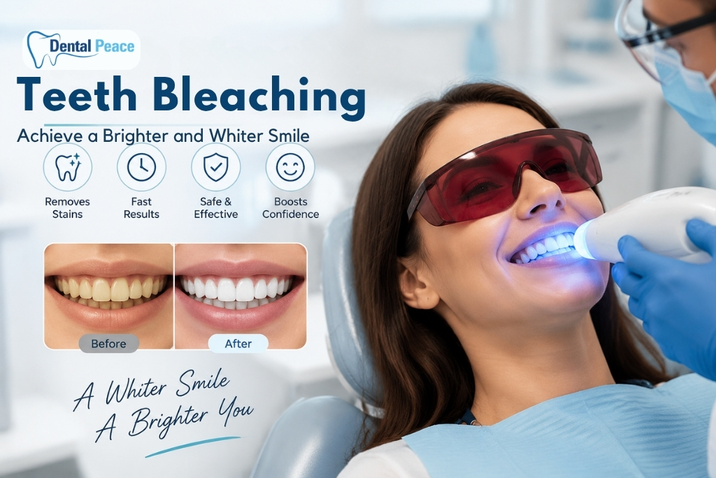 Teeth Bleaching